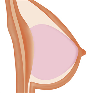 Sex Doll Gel-Filled Breasts