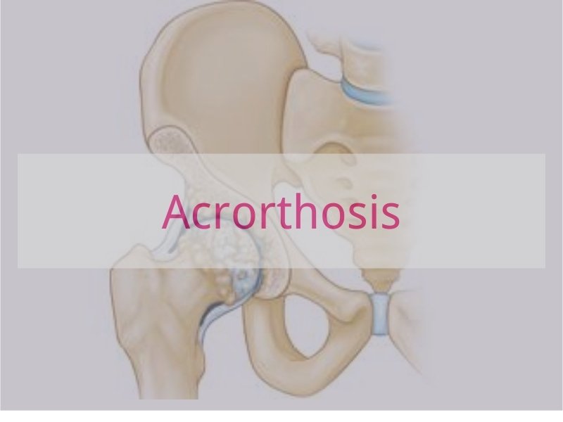 Acrorthosis