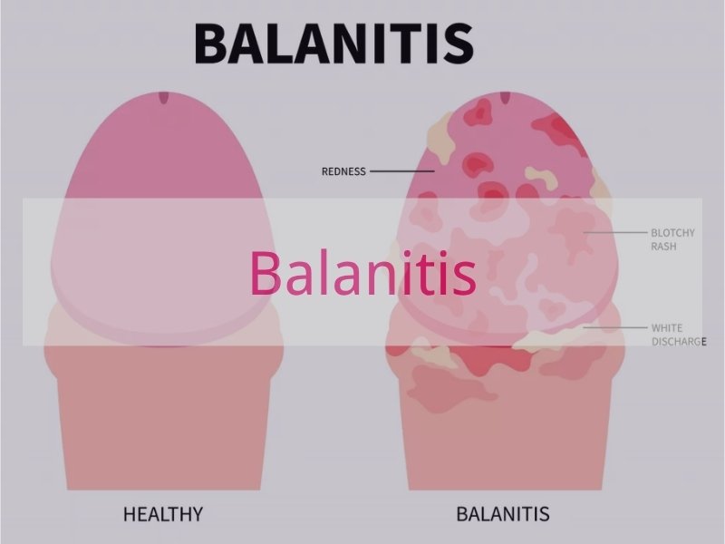 Balanitis
