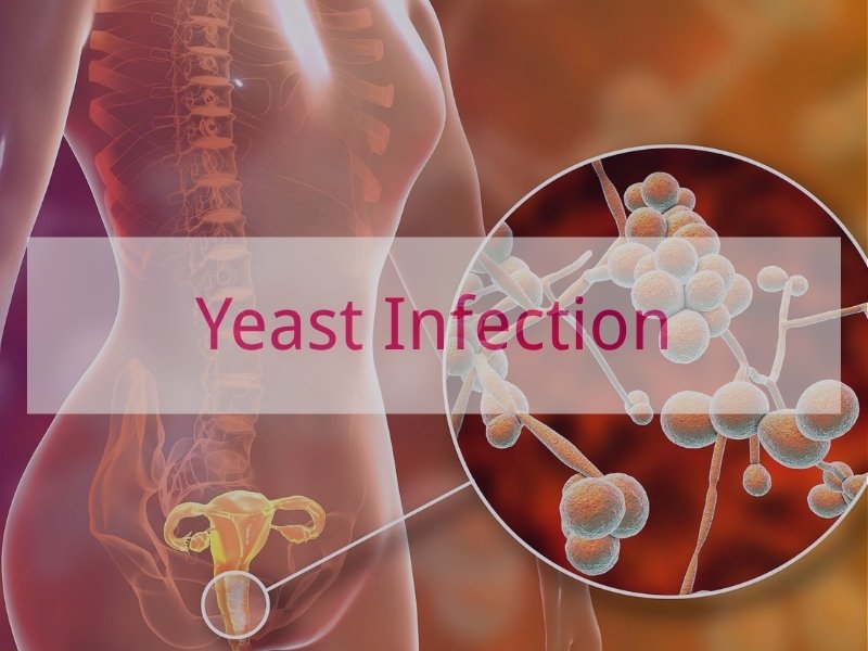 Yeast Infection