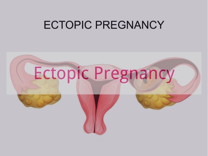 Ectopic Pregnancy