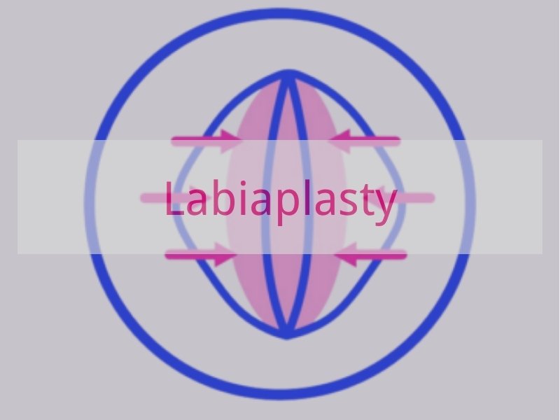 Labiaplasty