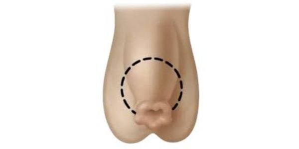 What is Uncircumcised Penis