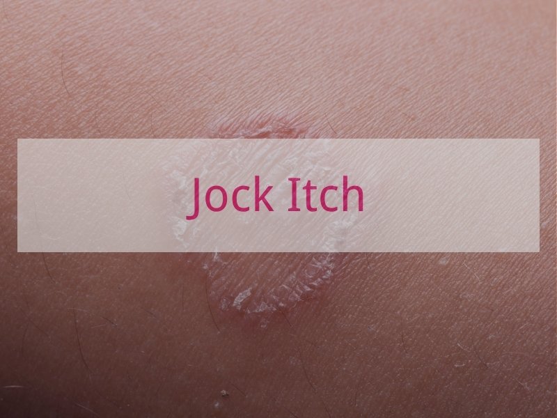 Jock Itch
