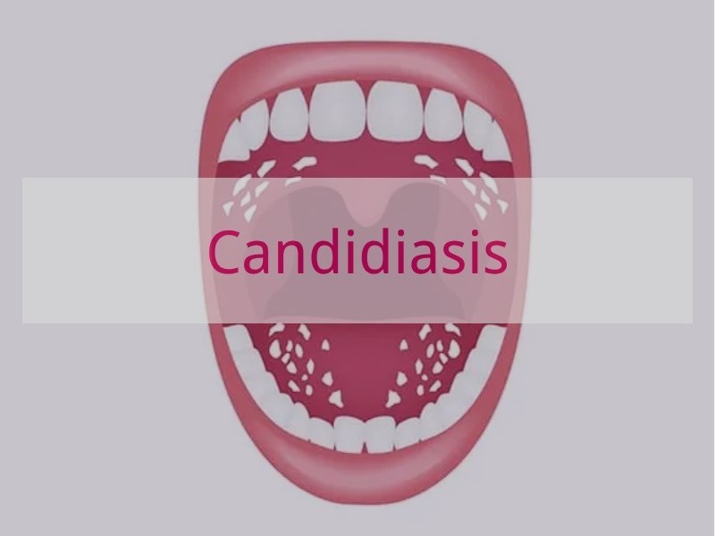Candidiasis