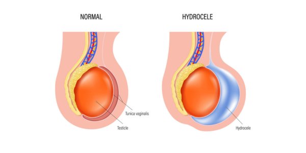 What is Saline Balls