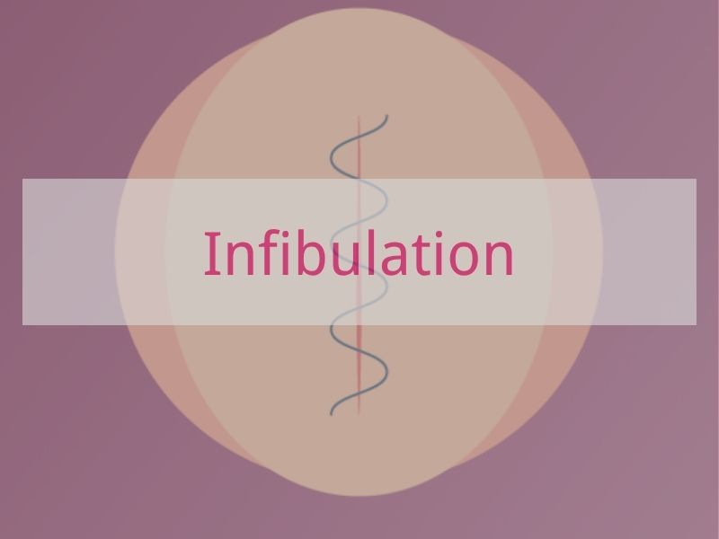 Infibulation