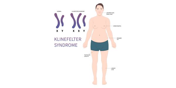What isKlinefelter&rsquo;s Syndrome