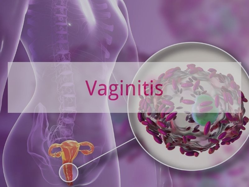 Vaginitis