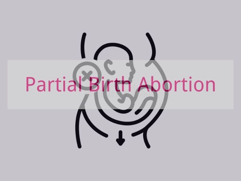 Partial Birth Abortion