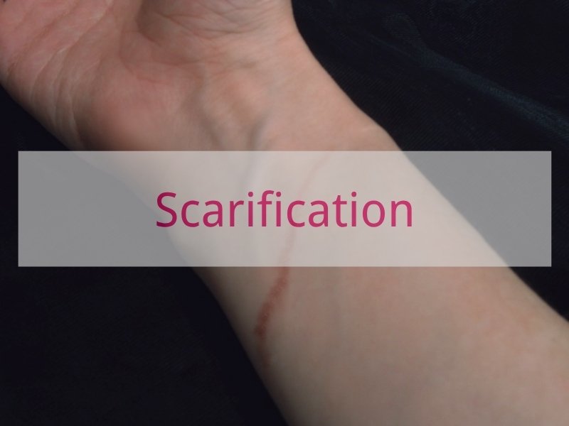 Scarification