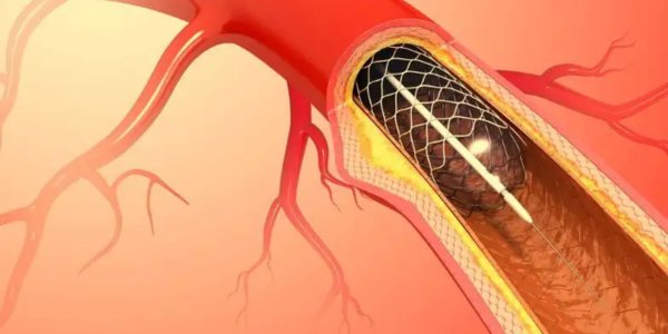 What is Catheterization