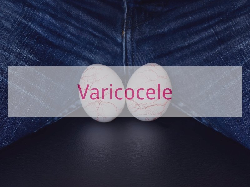 Varicocele