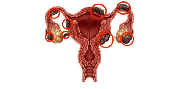 What is Endometriosis