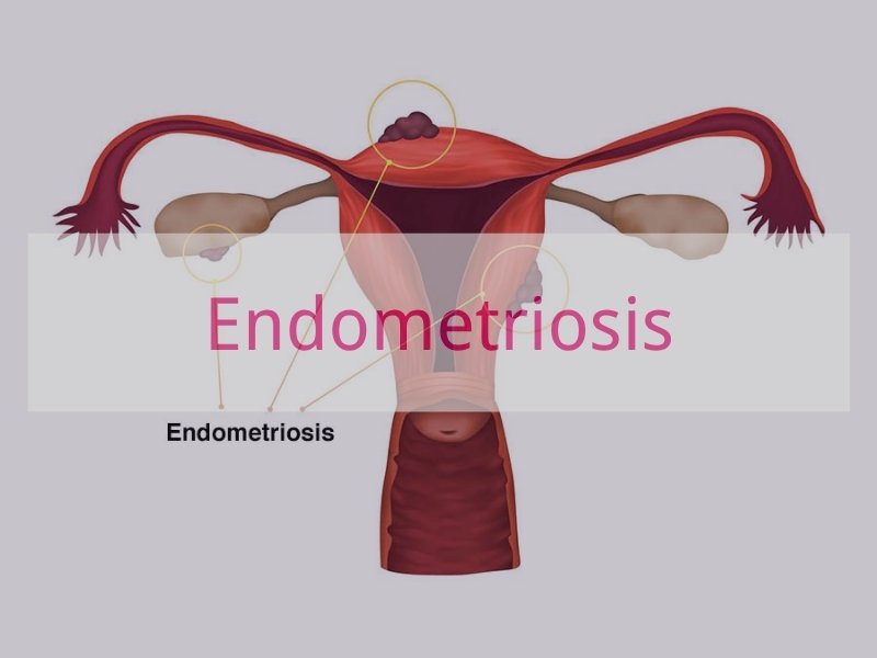 Endometriosis