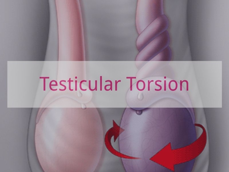 Testicular Torsion