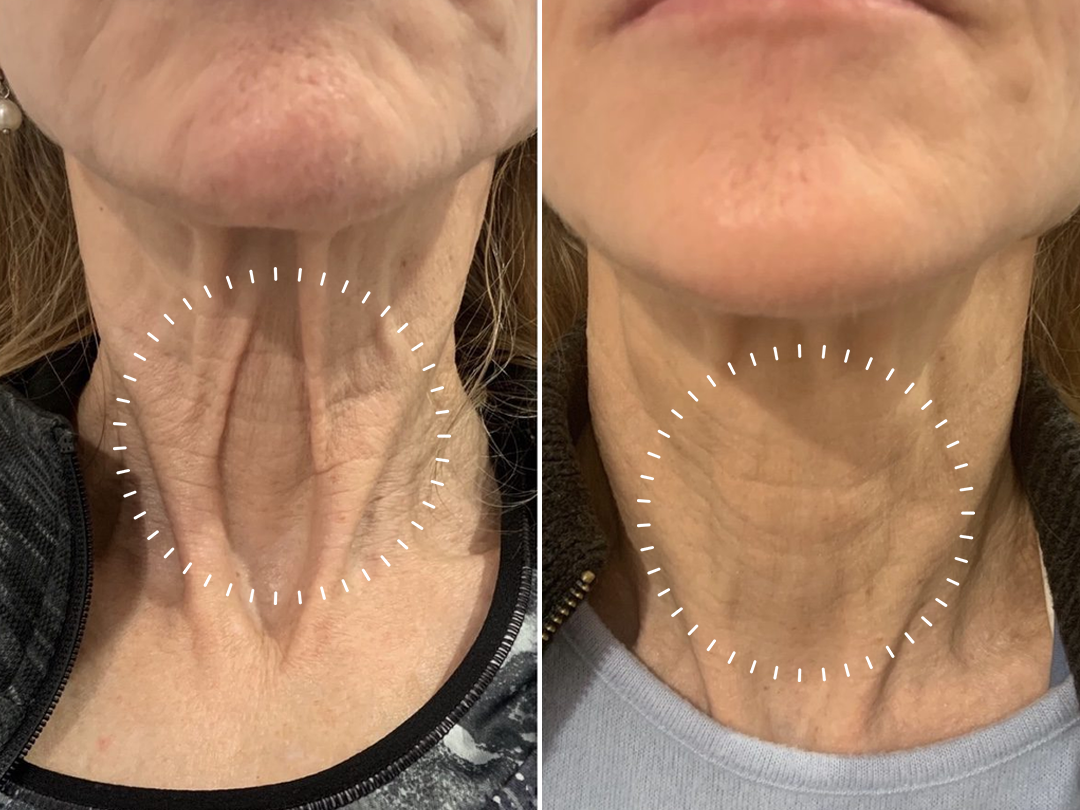 ✨FDA Approved: Ourlyard® Bee venom Pro Comprehensive Cream —🧬Limited Time 80% OFF🧬