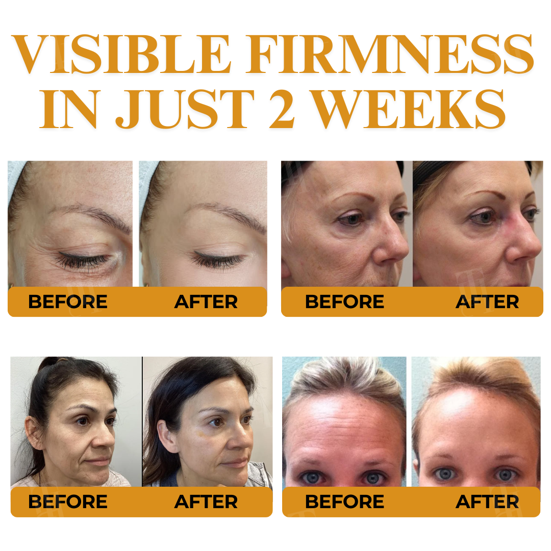 AEXZR® Letybo Bee Venom Wrinkle Removal Cream 🐝 The Bee-Venom Peptide Revolution: Mimics Letybo’s Effects Without Needles for “Botox-Like” Smoothing.