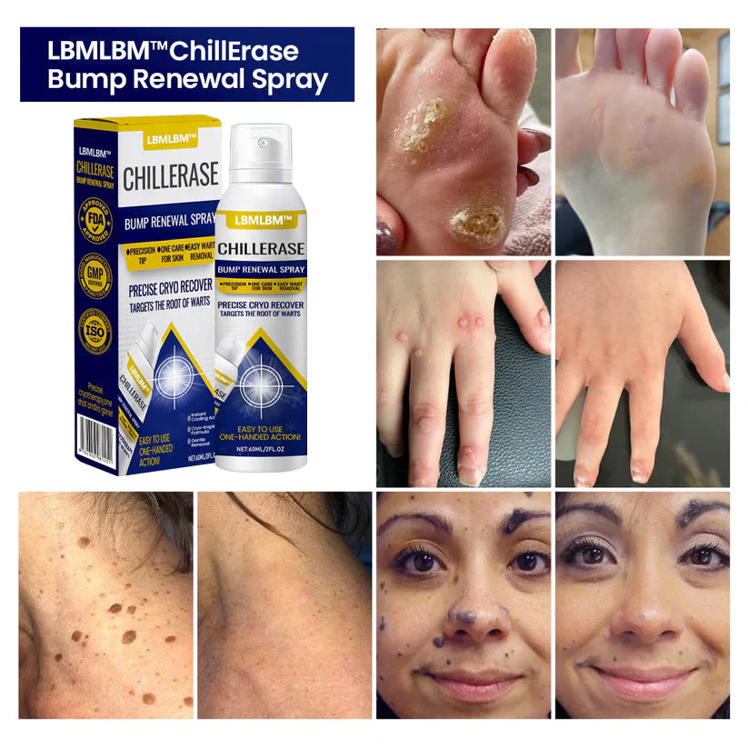 LBMLBM™ ChillErase Bump Renewal Spray🇺🇸👨‍⚕️⚕️ FDA Certified （Zero Pain, Smooth Skin | Flatten Bumps Fast | Calm Redness & Irritation | ）🔥🎁